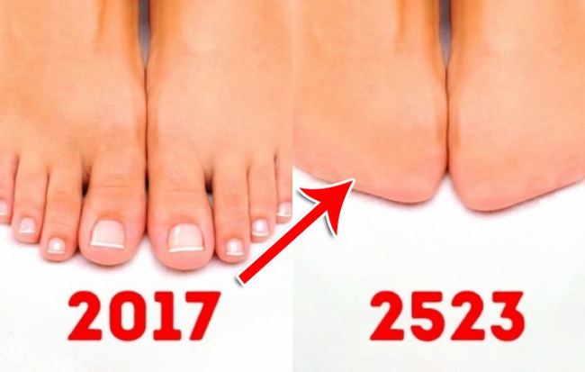 Ngón chân bị cắt giảm quân số