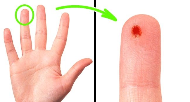 Tại sao ngón tay đeo nhẫn thường được dùng để làm xét nghiệm máu?