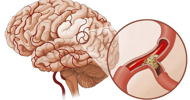 Bất kỳ ai, ở bất kỳ độ tuổi nào cũng có thể bị đột qụy bất ngờ 
