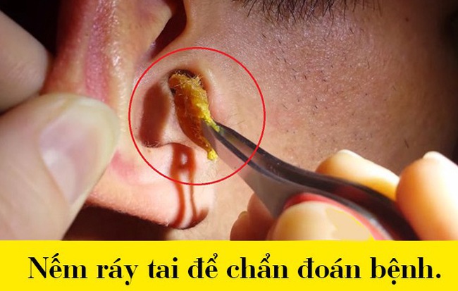 Chuẩn đoán bệnh bằng cách nếm ráy tai