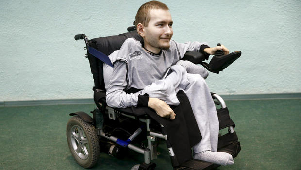 Valery Spiridonov, bệnh nhân bị teo cơ tủy tình nguyện tham gia ca ghép đầu đầu tiên 