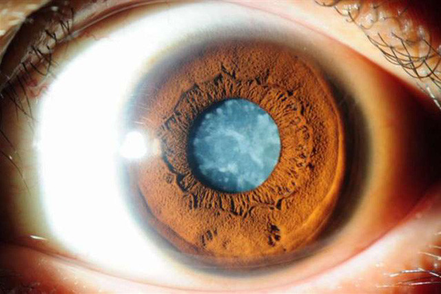 Phẫu thuật đục thủy tinh thể làm giảm nguy cơ tử vong ở phụ nữ lớn tuổi