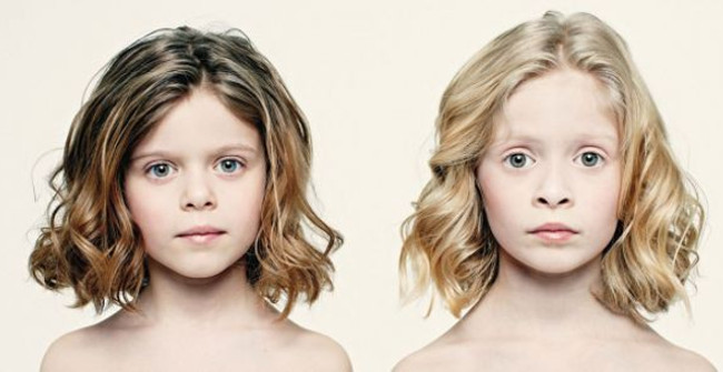 Cặp song sinh nhưng hòa vào làm 1