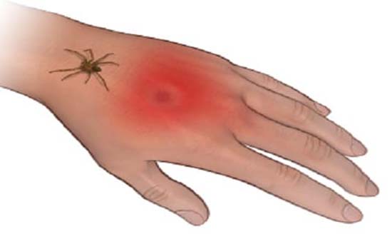 Cách xử lý khi bị nhện cắn.