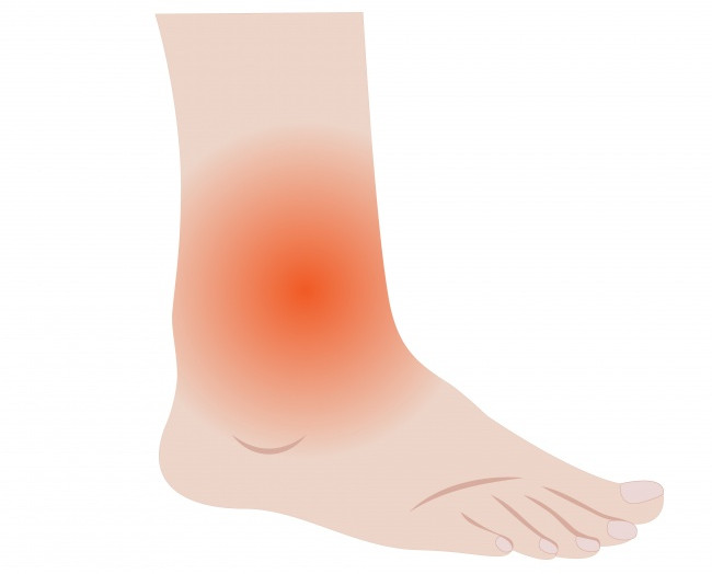 Sưng phù chân tay