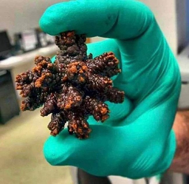 Hòn đá không hề nhỏ này được lấy ra từ cơ thể con người!