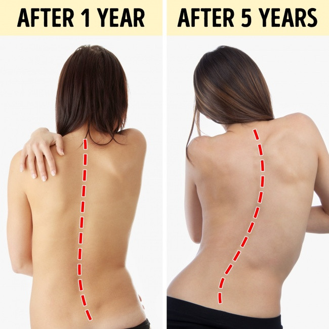 Cong vẹo cột sống