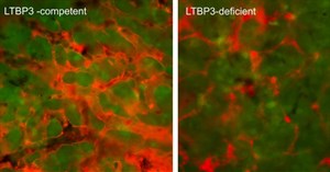 Các nhà khoa học tìm ra protein có thể ngăn ngừa ung thư di căn