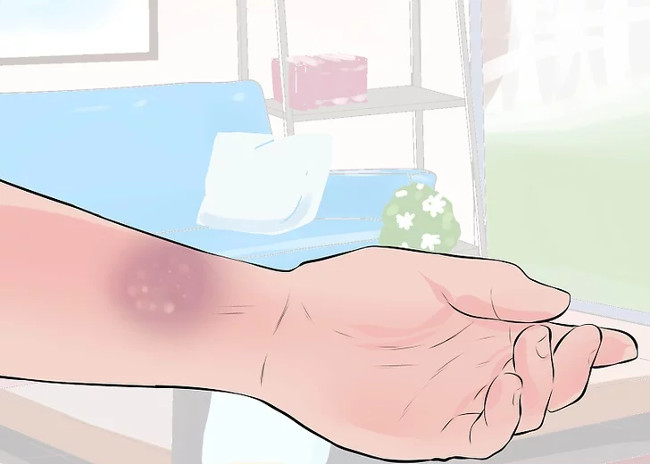 Kiểm tra hiện tượng bầm tím vào ngày hôm sau