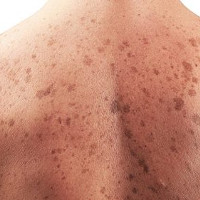 Phát hiện thú vị: Tìm thấy một vi khuẩn có thể giúp ngăn ngừa ung thư da