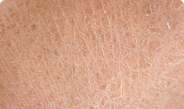 Da xuất hiện những vết nứt nẻ hoặc bị kích ứng do thiếu độ ẩm (ngứa rát khi trời lạnh).