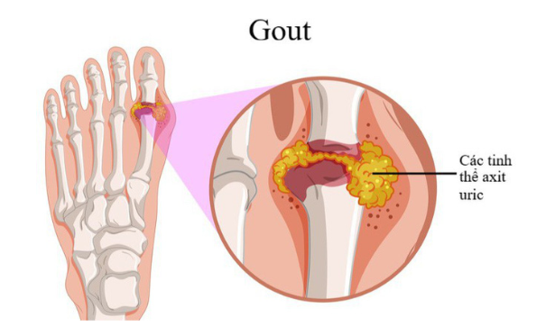 bệnh gout