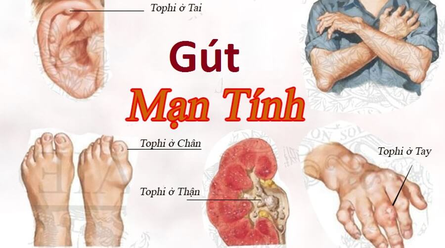 bệnh gút mãn tính