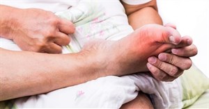 Phân biệt các bệnh gout cấp tính, mãn tính và bệnh giả gout