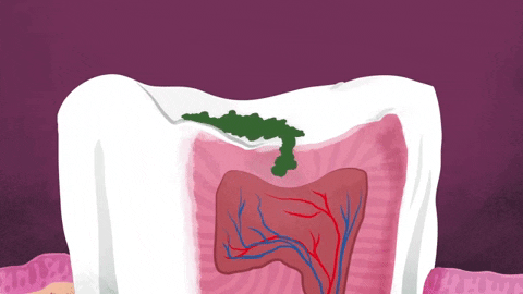 Dần dần, axit ăn mòn lớp men bảo vệ bên ngoài răng và mở ra con đường để vi khuẩn tấn công vào lớp thứ hai gọi là ngà răng