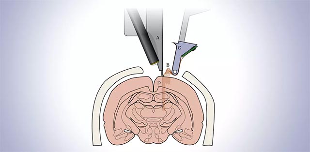 Có phải ai cũng phù hợp với công nghệ này