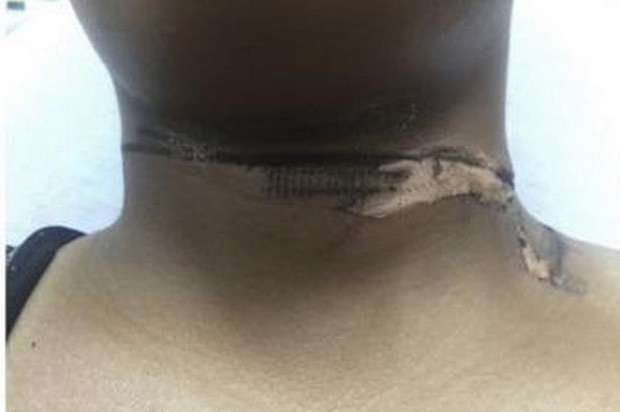 Cô gái bị bỏng do dùng cáp sạc đểu