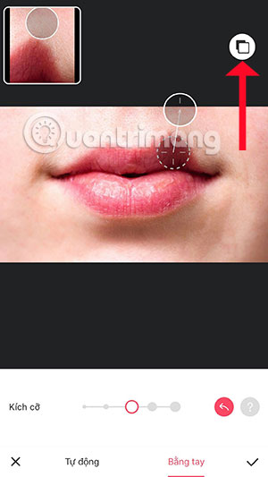 Chỉnh môi cánh én