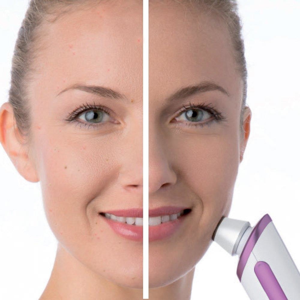 máy hút mụn cầm tay