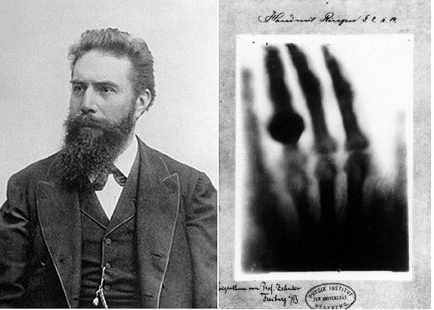 Wihelm Roentgen và bức ảnh X Quang bàn tay của ông.
