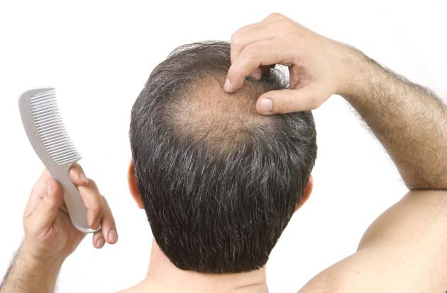 Chứng hói đầu ở nam giới là một trong những rắc rối phổ biến nhất đối với các quý ông