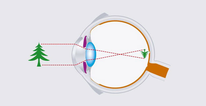 Khoảng cách giữa giác mạc và võng mạc bị nới rộng, hoặc giác mạc có độ cong quá lớn sẽ gây ra cận thị.