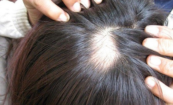 Nhổ tóc bạc gây hói đầu