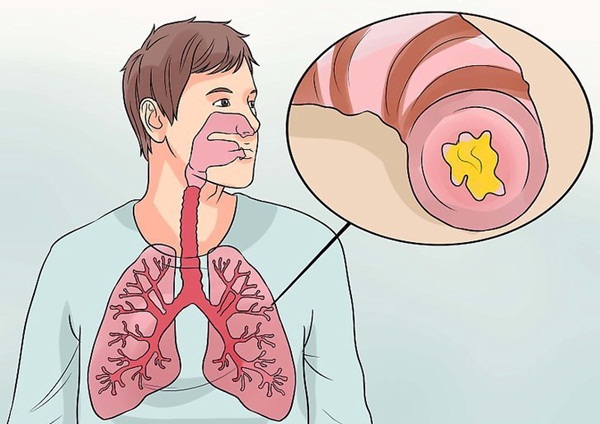 có nên khạc đờm không?