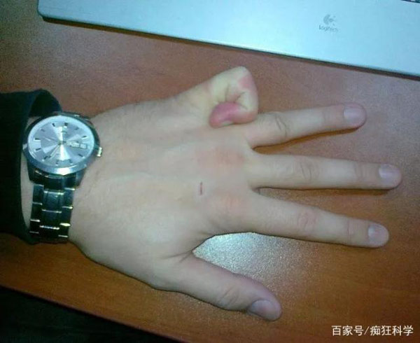 Xoắn ốc ngón út