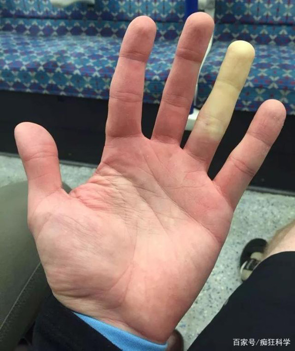 một số người khi gặp lạnh chỉ có phần ngón tay của họ chuyển sang màu trắng