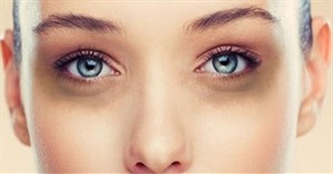 Mắt thâm quầng là biểu hiện của bệnh gì? Trị thâm mắt tại nhà có được không?