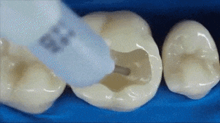 Cách mà các bác sĩ hàn chiếc răng sâu cho bạn