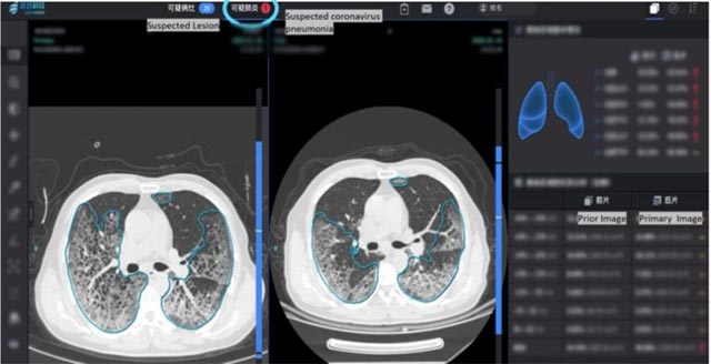 Ảnh CT phổi của bệnh nhân Covid 19