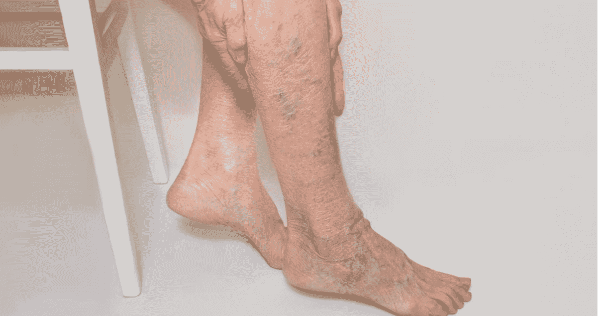 Hậu quả của bệnh suy tĩnh mạch