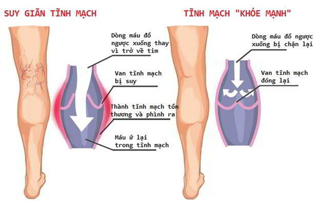 Suy giãn tĩnh mạch là bệnh gì?