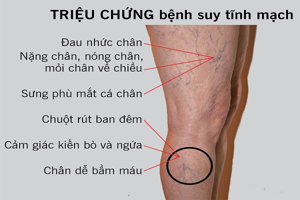Chuột rút vào ban đêm là một trong số những biểu hiện đầu tiên của suy giãn tĩnh mạch