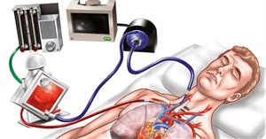 ECMO là gì? Khi nào cần can thiệp ECMO?