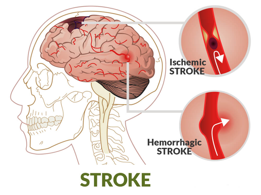 Phân loại đột quỵ
