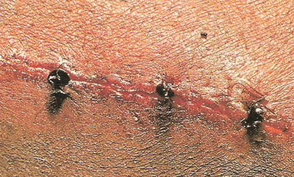 The wound is healed by the head of army ants 2