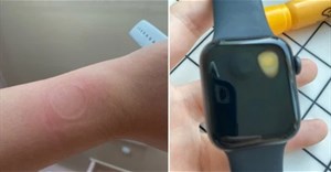 Apple Watch SE bị lỗi nghiêm trọng, nóng tới nỗi gây bỏng cho người dùng và hỏng màn hình