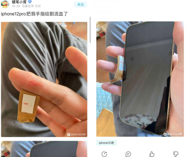 Một người dùng tại Trung Quốc chụp lại vết thương và cho biết nguyên nhân là do iPhone 12 gây nên. Ảnh: Weibo.