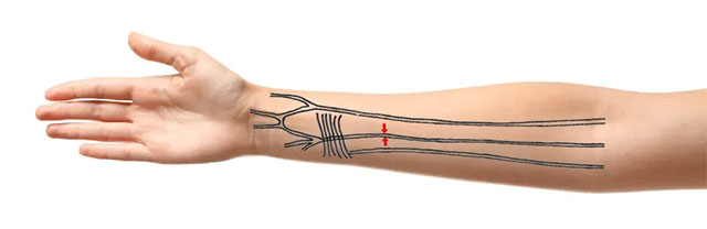 Vị trí động mạch giữa cẳng tay