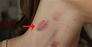 Hickey là gì?