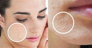 6 cách chăm sóc da mùa đông để không bị khô, rát, nứt nẻ