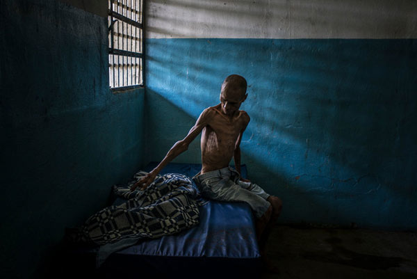 Omar Mendoza, một bệnh nhân tâm thần phân liệt trong tình trạng gầy gò tại Bệnh viện El Pampero, Barquisimeto, Venezuela. Nền kinh tế của quốc gia này bị sụp đổ đã dẫn đến tình trạng thiếu lương thực và các loại thuốc cần thiết để kiểm soát các cơn đau tâm thần của bệnh nhân.