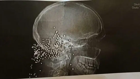 Một người đàn ông vô tình bị vợ bắn vào đầu. Và trong hình là ảnh chụp x-quang cho thấy các vết đạn găm trong đầu anh ta.