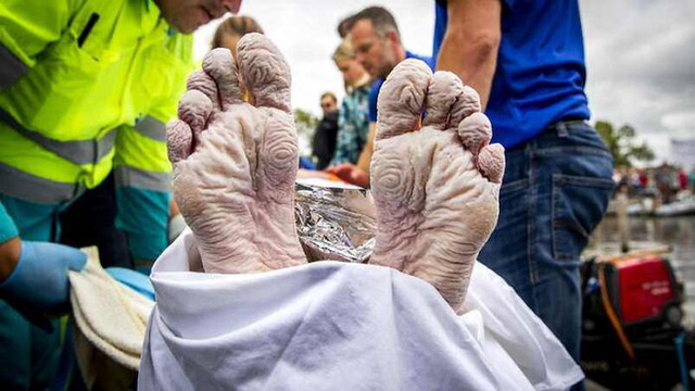 Đôi chân của Maarten Van Der Weijden - nhà vô địch bơi lội Olympic Hà Lan sau khi bơi 163 km trong 55 giờ để quyên tiền cho nghiên cứu ung thư.