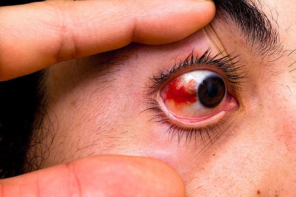 Nếu bạn nhịn hắt hơi có thể sẽ khiến mạch máu trong mắt bị vỡ.