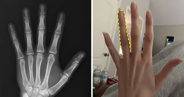 Ngón tay của bạn càng dài, bạn càng có nhiều testosterone