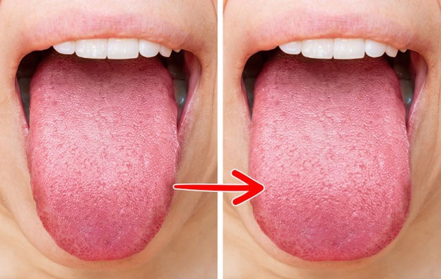 Lưỡi cũng béo lên 